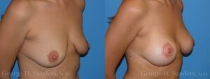 Patient 7c Breast Lift Before and After