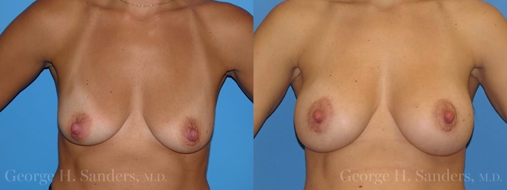 Patient 9a Breast Lift Before and After
