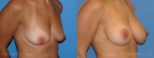 Patient 9b Breast Lift Before and After