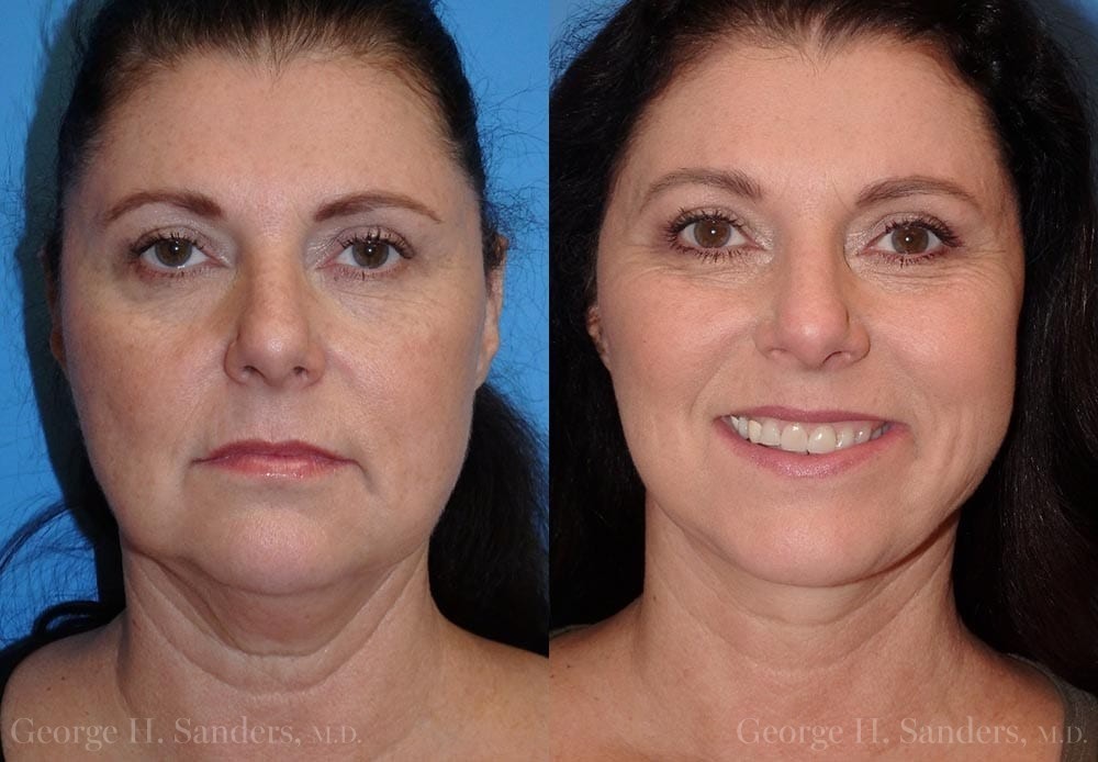 Patient 17a Face Lift Before and After