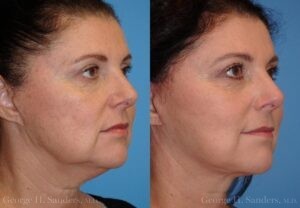 Patient 17b Face Lift Before and After