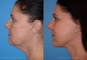 Patient 17c Face Lift Before and After