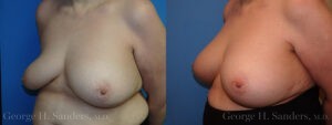Patient 12b Breast Capsules Before and After