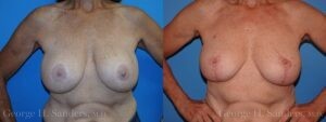 dr-sanders-los-angeles-breast-capsules_patient-13-1