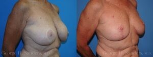 dr-sanders-los-angeles-breast-capsules_patient-13-2