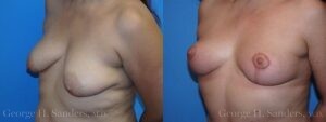 dr-sanders-los-angeles-breast-lift-patient-12-2