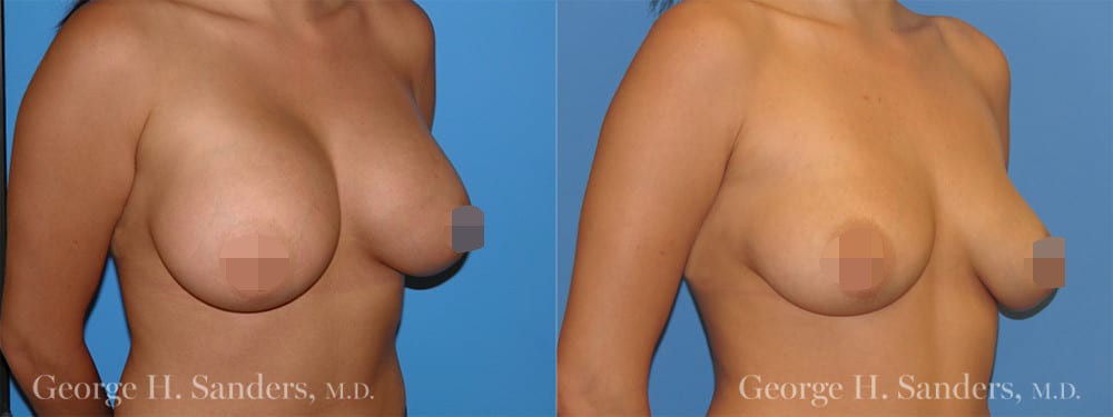 dr-sanders-los-angeles-Breast-implant-removal_patient-1-3_CENSORED