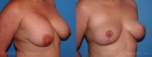 dr-sanders-los-angeles-breast-implant-removal-patient-6-2
