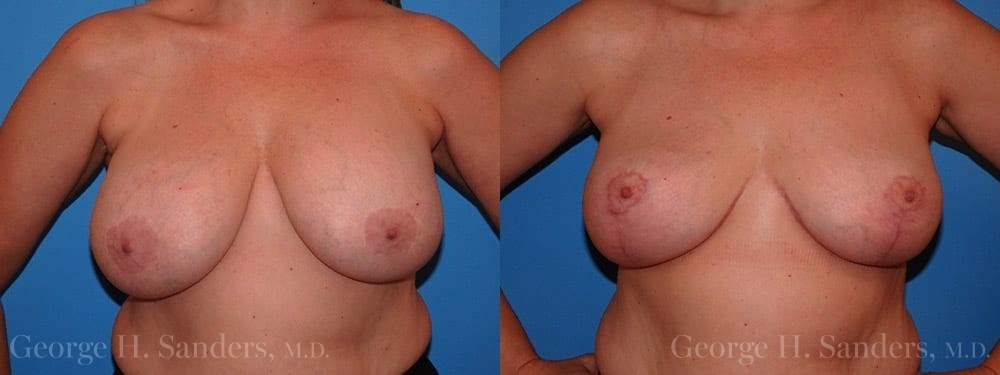 dr-sanders-los-angeles-breast-implant-removal-patient-patient-7-1