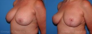 dr-sanders-los-angeles-breast-implant-removal-patient-patient-7-2
