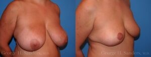 dr-sanders-los-angeles-breast-reduction-patient-17-3