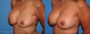 dr-sanders-los-angeles-breast-capsulectomy-patient-18-2