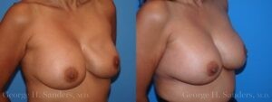 dr-sanders-los-angeles-breast-capsulectomy-patient-18-3