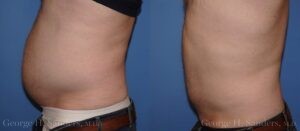 dr-sanders-san-fernando-valley-male-liposuction-patient-2-2