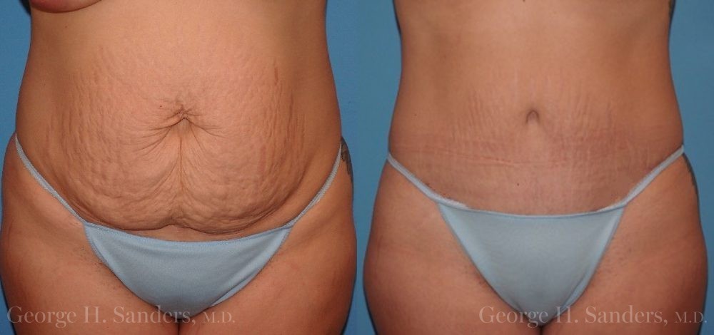Patient 11858a Tummy Tuck Before and After